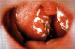 Mandulagyulladás (Tonsillitis)
