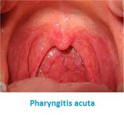 A garatnyálkahártya heveny gyulladása (Pharyngitis acuta)