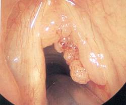gége papillomatosis és tracheostomia