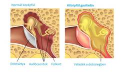 Kzpflgyullads (Otitis media)