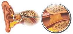 Flzsrdug (Cerumen)