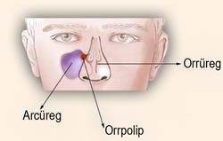 Orrpolyp