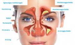 Arcreggyullads (Sinusitis maxillaris)