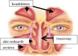 Orrsvnyferdls (Septumdeviatio)